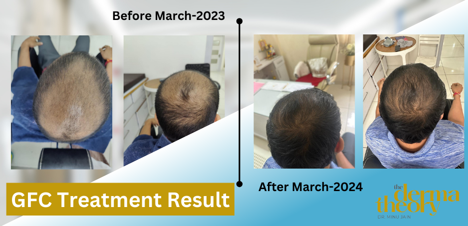 Fue Hair Transplant Treatment Bangalore